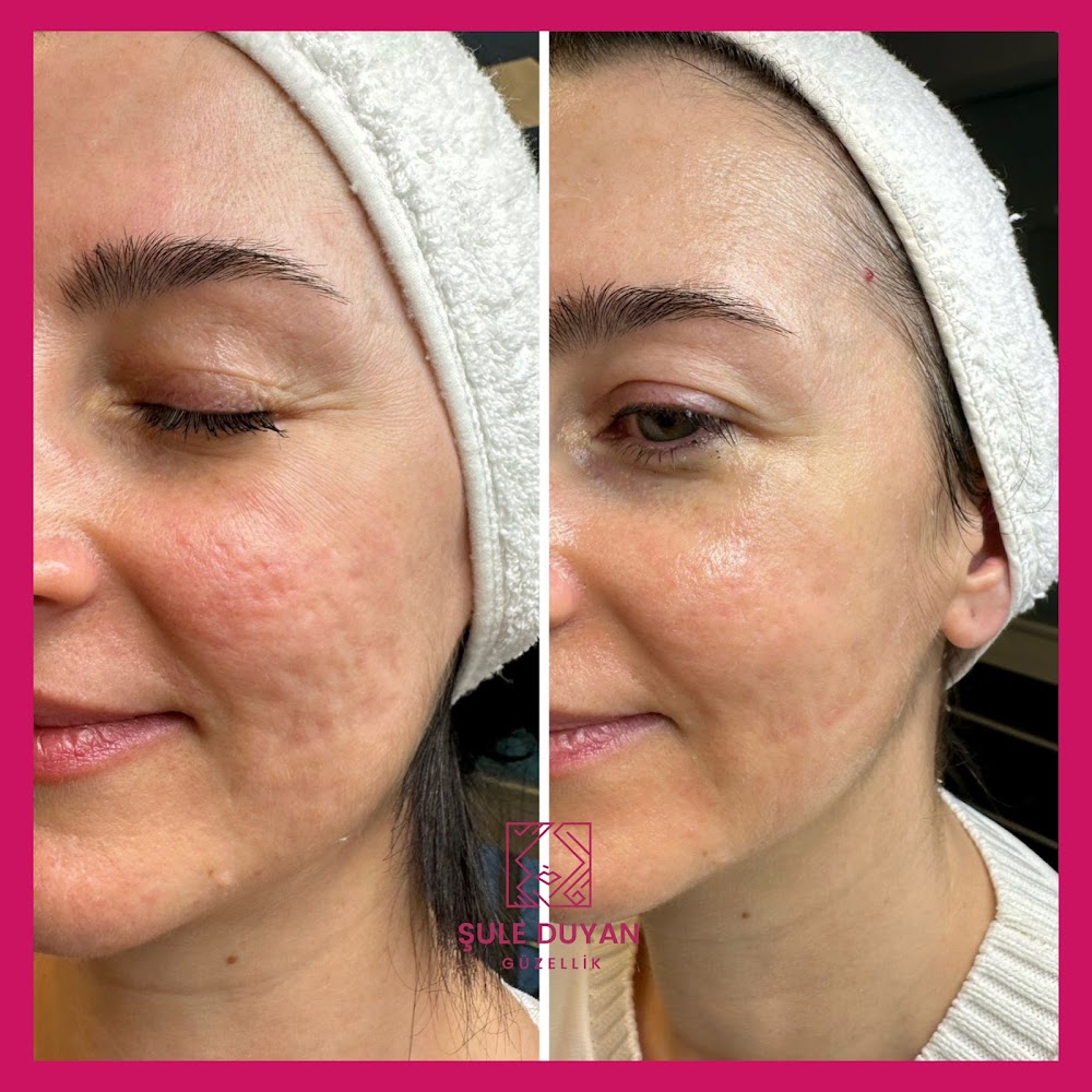 Şule Duyan Beauty Clinic - Hydrafacial / Medical Aesthetic / Laser Hair Removal