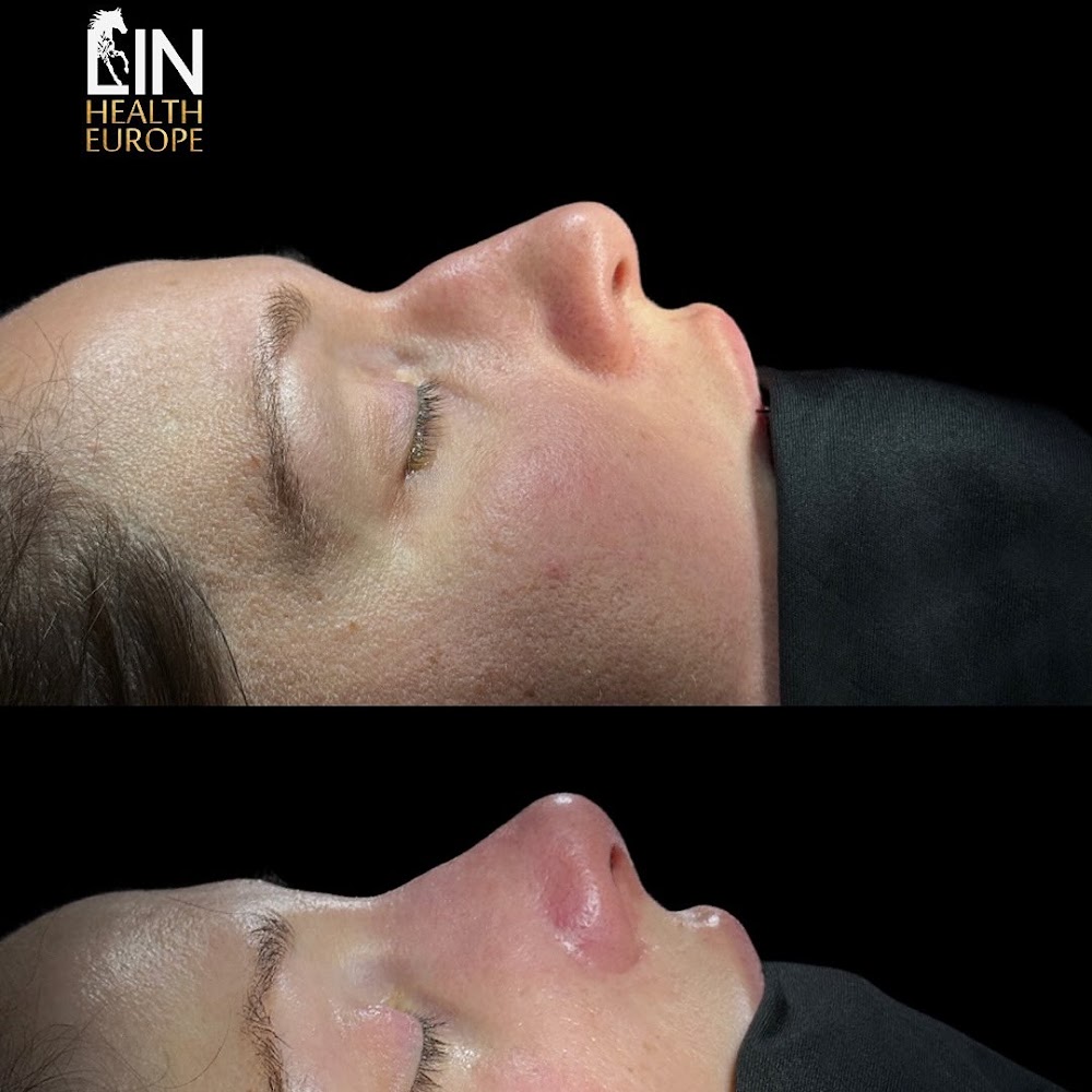 Hair Transplant Turkey: Lin Europe Clinic | Rhinoplasty in Istanbul Turkey | Best Plastic Surgery Reviews, Best Turkey Clinic