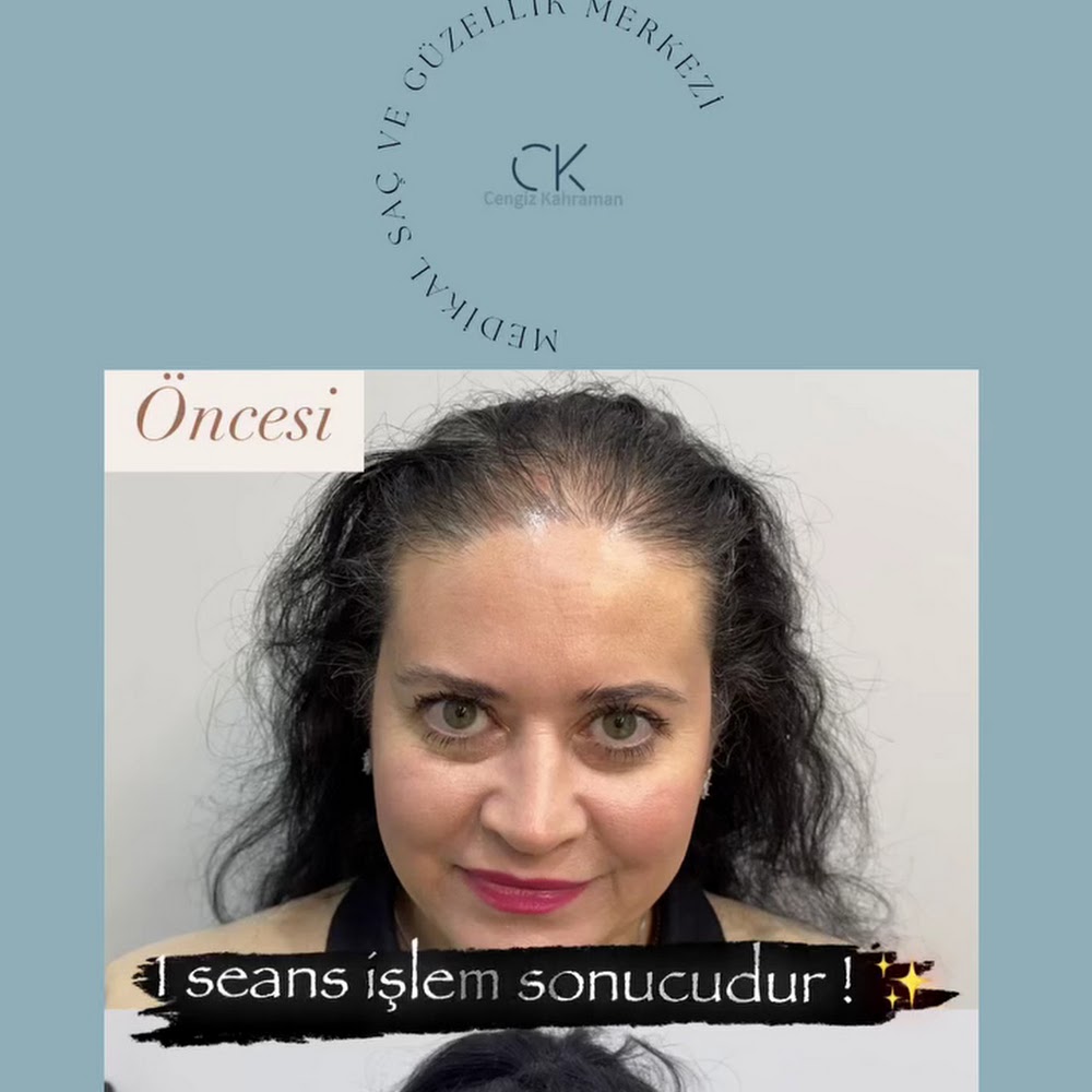 Saç Simülasyon ve Güzellik Merkezi CK Cengiz Kahraman - 3